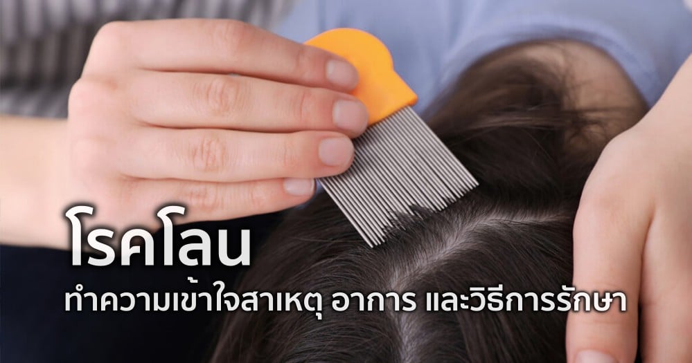 โลน (Pubic Lice): สาเหตุ อาการ และการรักษา